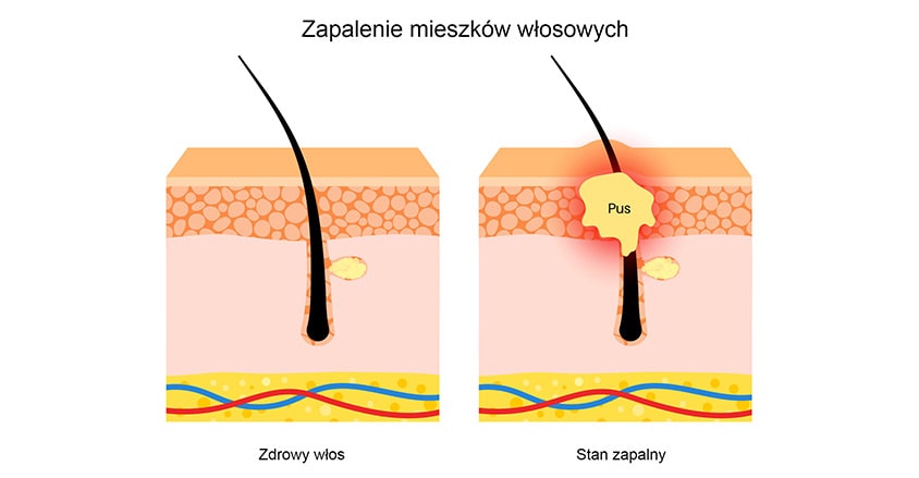 Grafika przedstawiająca zdrowy włos i zapalenie mieszka włosowego