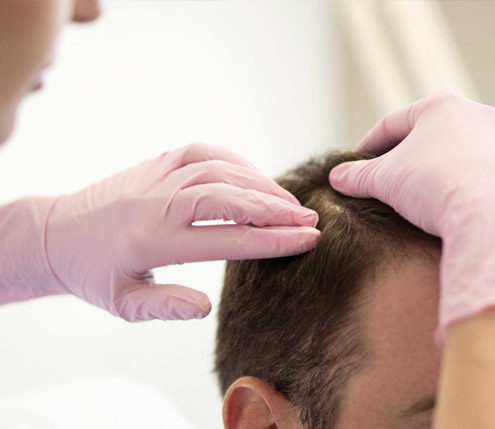 Lekarz trycholog sprawdzający skórę głowy mężczyzny, któremu wypadają włosy